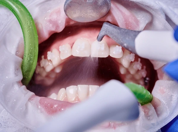 Dental Prophylaxis: What to Expect and How It Supports Oral Health
