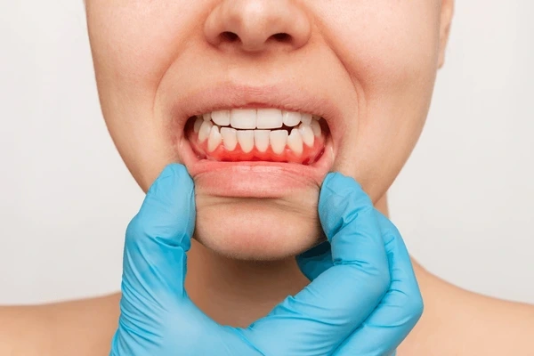 Gum Disease,Immune Response,and Bone Loss:Non-Surgical Options and Home Care