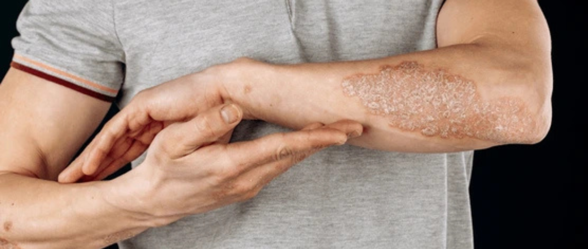 Psoriatic Arthritis Guide: Symptoms, Causes & Management Tips