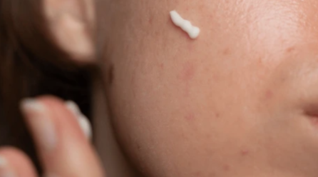 Do Retinoids Help Reduce Wrinkles? Evidence and Effectiveness