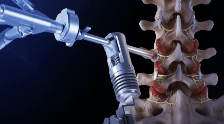 Rhizotomy: Uses, Benefits, and Recovery