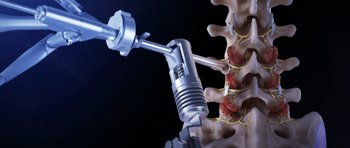 Rhizotomy: Uses, Benefits, and Recovery