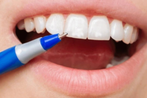 White Spots on Teeth: Tips for Healthier Smiles