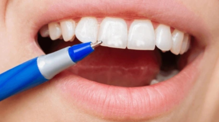 White Spots on Teeth: Tips for Healthier Smiles