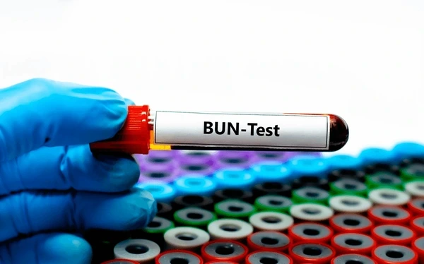 Blood Urea Nitrogen (BUN) test blood sample tube for kidney function analysis