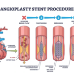 Next-Gen Stents Restoring Coronary Artery Blood Flow Medical infographic diagram illustrating the step-by-step angioplasty and stent procedure restoring blood flow in an occluded coronary artery.