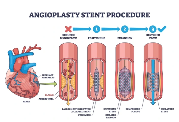 Medical infographic diagram illustrating the step-by-step angioplasty and stent procedure restoring blood flow in an occluded coronary artery.