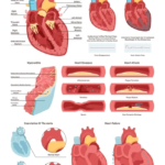 Non-Invasive Vascular Imaging - Heart Anatomy and Plaque Buildup Medical infographic of heart anatomy and surrounding blood vessels showing arterial plaque buildup and atherosclerosis stages.